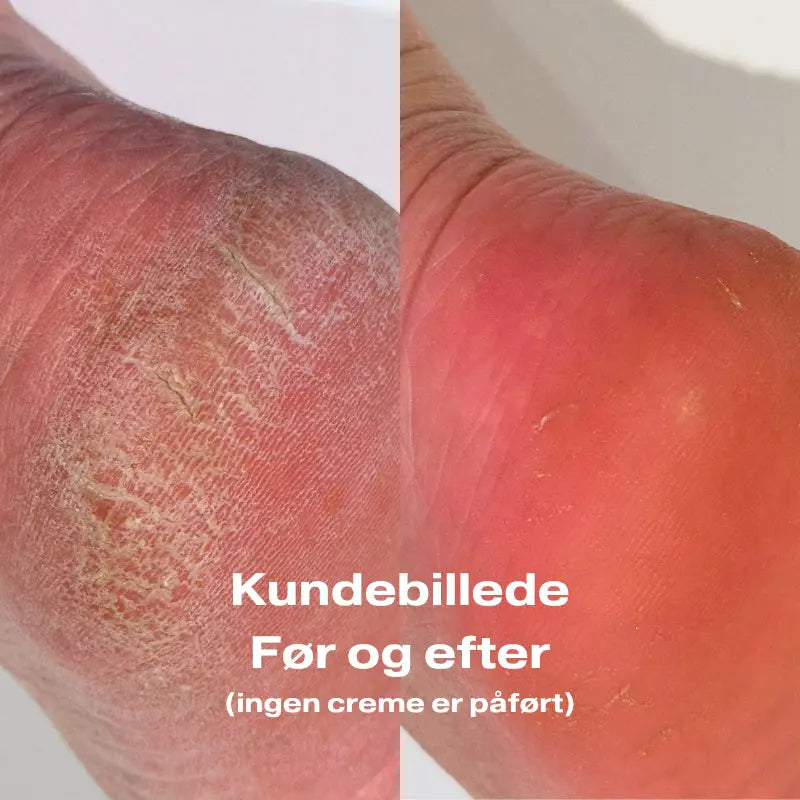 Baren - Foot Callus Eraser Home Set (Mist + Foot File) BAREN