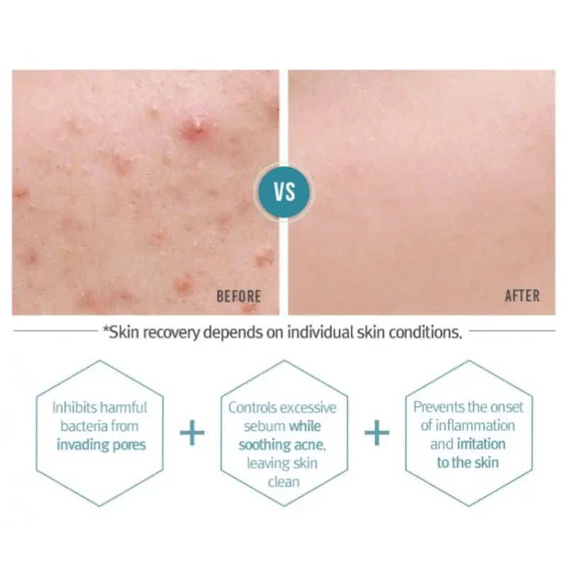 Acne Cream Pyunkang Yul