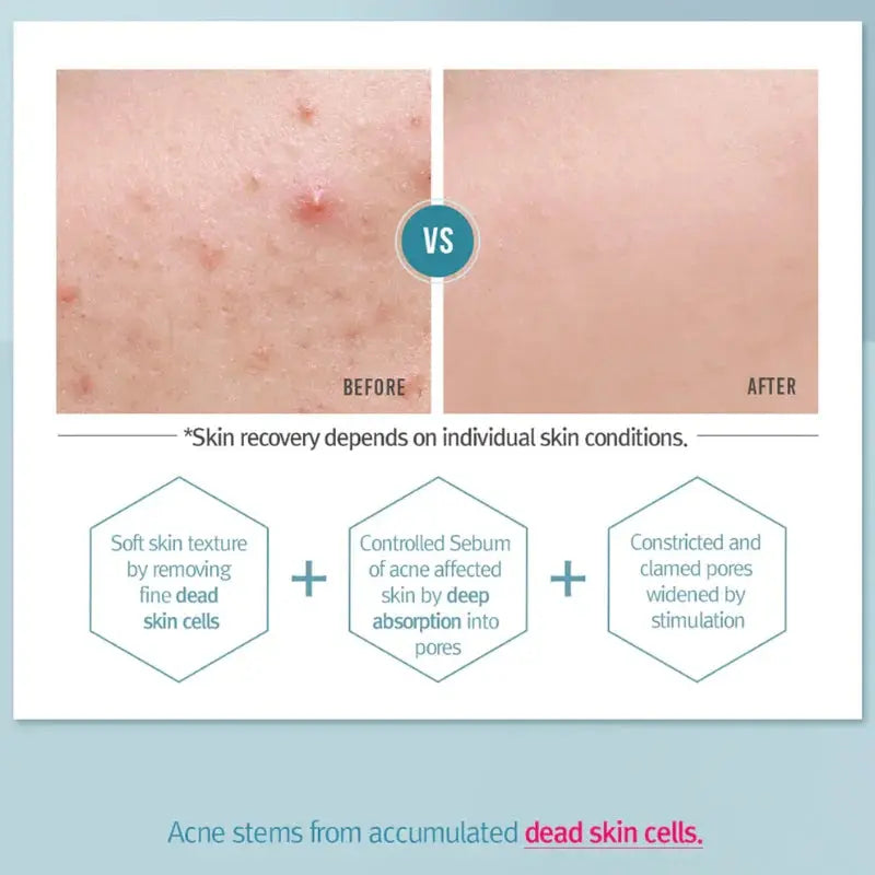 Acne Toner Pyunkang Yul